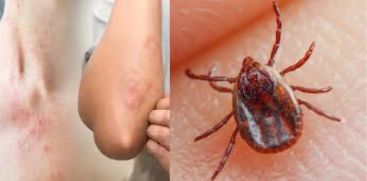 Scrub Typhus is Rapidly Spreading  in Kerala