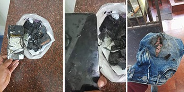 The Mobile Phone Exploded And The Young Man Burnt