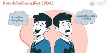 What is the rare disease called Pseudobulbar Affect? Know the causes and symptoms