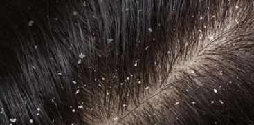 5 Tips To Cure Dandruff