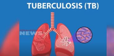 tuberculosis