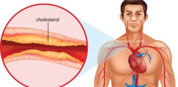 Are you struggling with cholesterol? So here is the solution