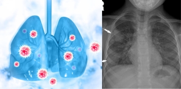 Double Pneumonia