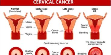 what is cervical cancer?