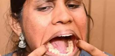 MOST TEETH RECORD OF WOMEN