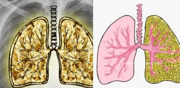 What is popcorn lung disease that causes lung problems?