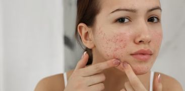 Home Remedies for Pimples