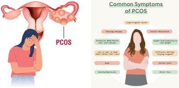 Studies show that PCOS may cause psychological problems