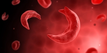 Sickle Cell Disease