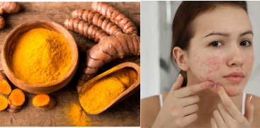 Turmeric for Acne